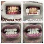Teeth whitening case