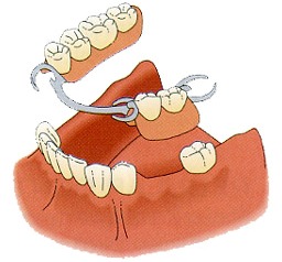 Partial denture