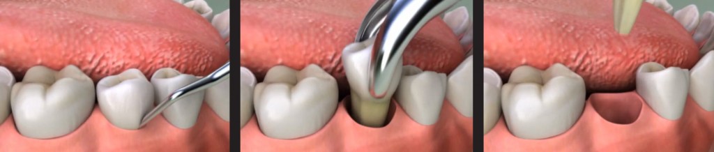 Tooth extraction