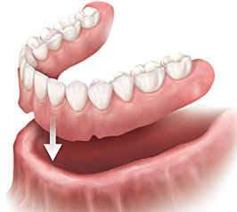 Complete denture