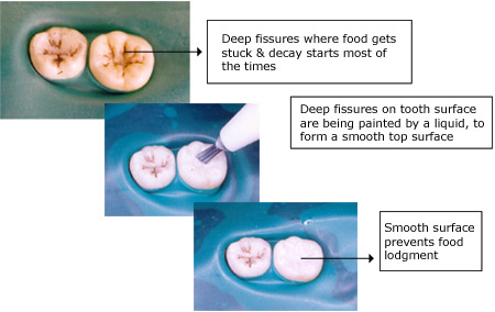 Prevention of cavities