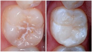 Fissure sealant
