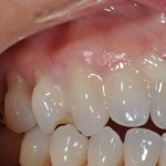 Fluoride treatment