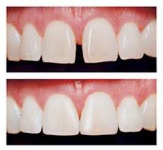 Porcelain Laminates (Veneers)
